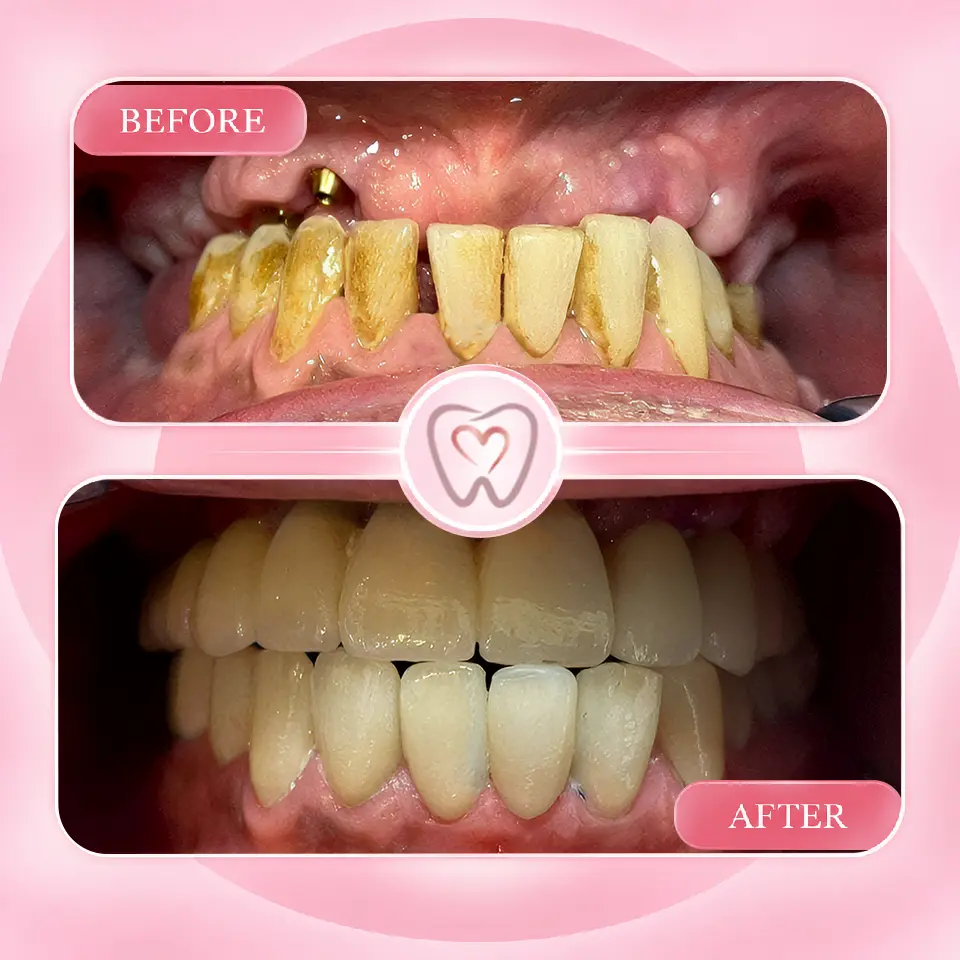 Dental implant procedure