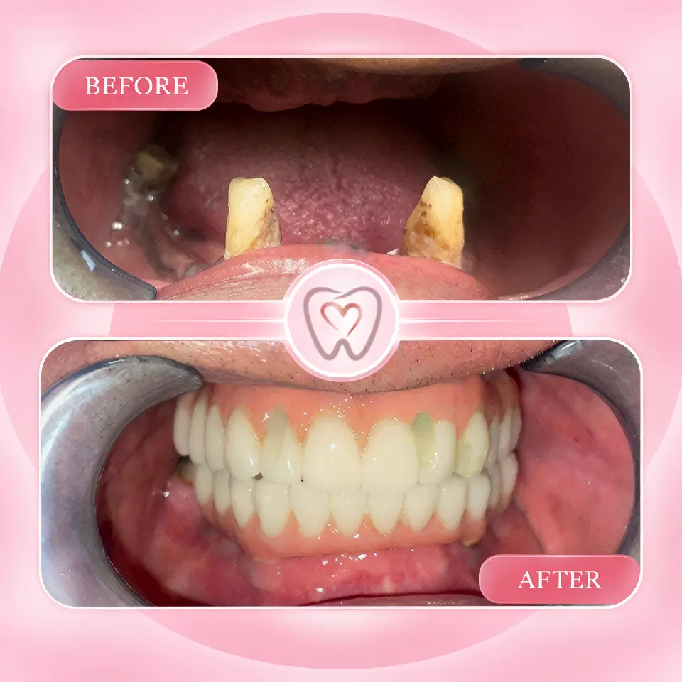 Dental implant procedure