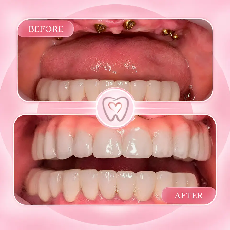 Dental implant procedure